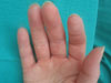 raynaud's before ets surgery