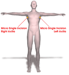 micro ets incisions