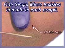 micro ets incision